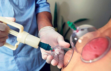 Hacamat tedavisi uygulaması